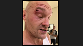 skysports-tyson-fury-cut-queensberry_6442194.png